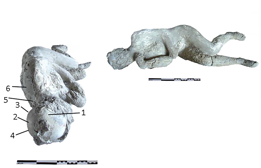 Victim 54. Two views of cast #54 and pXRF measuring points (1–6).
Photo courtesy of The Casts of Pompeii Project. Use subject to CC BY 4.0 Deed
The cast #54 was identified as a female adult (35–40 years).
This individual was found in a left lateral decubitus position, with the head resting on the left temporal parietal, the right arm with the elbow fully flexed and the forearm next to the chest.
No obvious pathological conditions in the individual #54 from Porta Nola, were observed
See Alapont L, Gallello G, Martinón-Torres M, Osanna M, Amoretti V, Chenery S, et al. (2023) The casts of Pompeii: Post-depositional methodological insights. PLoS ONE 18(8): e0289378, (Fig 6). https://doi.org/10.1371/journal.pone.0289378