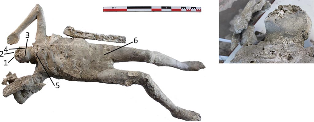 Victim 55. Cast #55 and pXRF measuring points (1–6).
The cast #55 belongs to a male adult between 25 and 30 years old, originally in supine position, with the upper extremities separated from the body, and the forearms and hands on the head.
The radiological examination also revealed traumatic perimortem fractures in the tibia and fibula of the right leg of the cast #58 and in the right humerus of the cast #55. These fractures appear to have occurred close to the time of death of the individuals.
Photo courtesy of The Casts of Pompeii Project. Use subject to CC BY 4.0 Deed
See Alapont L, Gallello G, Martinón-Torres M, Osanna M, Amoretti V, Chenery S, et al. (2023) The casts of Pompeii: Post-depositional methodological insights. PLoS ONE 18(8): e0289378, fig. 7. https://doi.org/10.1371/journal.pone.0289378