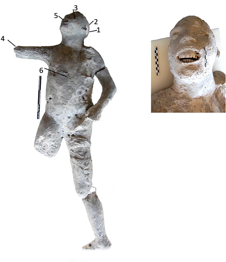Victim 57. Cast #57 and pXRF measuring points (1–6).
The cast #57 is an adult individual (25–30 years old). He was found supine and has some flexed or lopsided anatomical areas.
The skull is inclined to the right and the chest is straight, presenting its coxofemoral joint slightly rotated towards its medial aspect.
The cast #57 shows dental wear of the incisors and canines of the upper jaw, product of its axial shaft, and erosion of the lower incisors.
Photo courtesy of The Casts of Pompeii Project. Use subject to CC BY 4.0 Deed
See Alapont L, Gallello G, Martinón-Torres M, Osanna M, Amoretti V, Chenery S, et al. (2023) The casts of Pompeii: Post-depositional methodological insights. PLoS ONE 18(8): e0289378, Fig 2. https://doi.org/10.1371/journal.pone.0289378
Victim 57 is a young male aged 13-19 years.
Some imprints of the fabric of a tunic are visible near the side and the left thigh.
The body was found between the 2nd of August and the 21st of September 1976, outside the Porta Nola near the tomb of M. Obellius Firmus.
See Osanna, N., Capurso, A., e Masseroli, S. M., 2021. I Calchi di Pompei da Giuseppe Fiorelli ad oggi: Studi e Ricerche del PAP 46, p. 454-6, Calco n. 57.