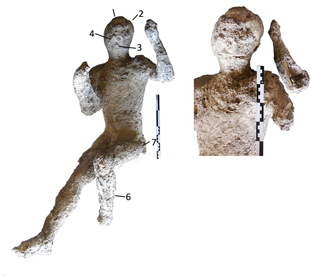 Victim 58. Cast #58 and pXRF measuring points (1–6).
Photo courtesy of The Casts of Pompeii Project. Use subject to CC BY 4.0 Deed
The cast #58 (Fig 4) is an adult individual (20–25 years old) identified as a male. This was divided into 7 parts before its restoration. This cast appears to preserve the morphology of the right ear.
Individual #58 also presents hypoplasia in the left lateral incisor and dental wear on the lower left lateral incisor, and also an enthesophyte of the left patella.
The radiological examination also revealed traumatic perimortem fractures in the tibia and fibula of the right leg of the cast #58. These fractures appear to have occurred close to the time of death of the individuals.
See Alapont L, Gallello G, Martinón-Torres M, Osanna M, Amoretti V, Chenery S, et al. (2023) The casts of Pompeii: Post-depositional methodological insights. PLoS ONE 18(8): e0289378, Fig 4. https://doi.org/10.1371/journal.pone.0289378
Victim 58 is an adult male aged over 20 years.
The body was found outside Porta Nola, near the tomb of M. Obellius Firmus, between the 2nd of August and the 21st of September 1976.
It seems we can distinguish some traces of clothing on the victim's torso and legs.
See Osanna, N., Capurso, A., e Masseroli, S. M., 2021. I Calchi di Pompei da Giuseppe Fiorelli ad oggi: Studi e Ricerche del PAP 46, p. 457-8, Calco n. 58.